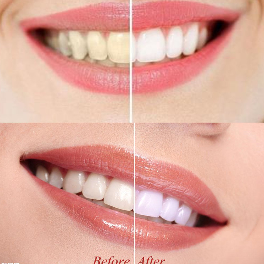 Than Tre Răng Răng Nha Khoa De - đánh giá và giá Teeth Whitening From Home