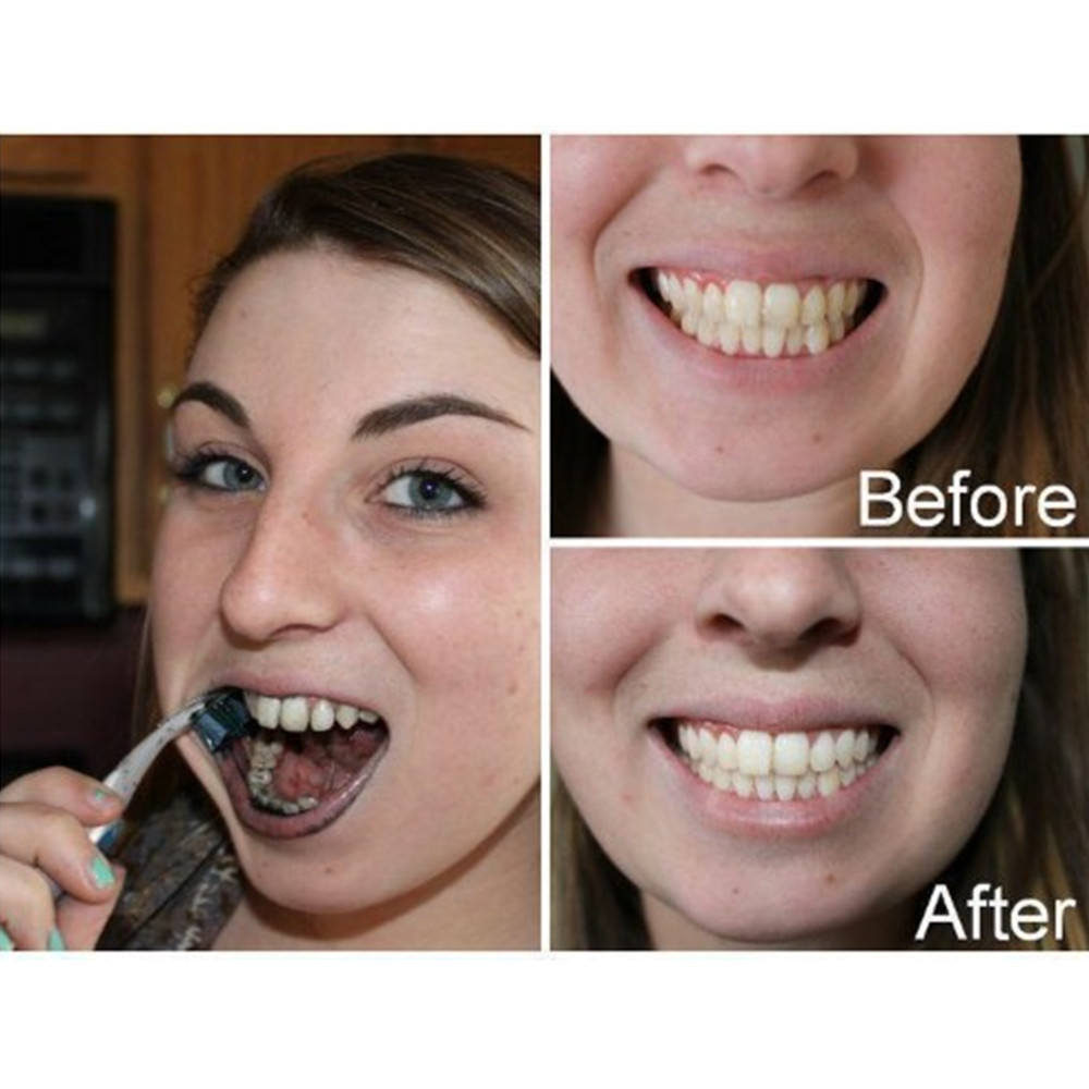 Than Tre Răng Răng Nha Khoa De - đánh giá và giá Teeth Whitening From Home