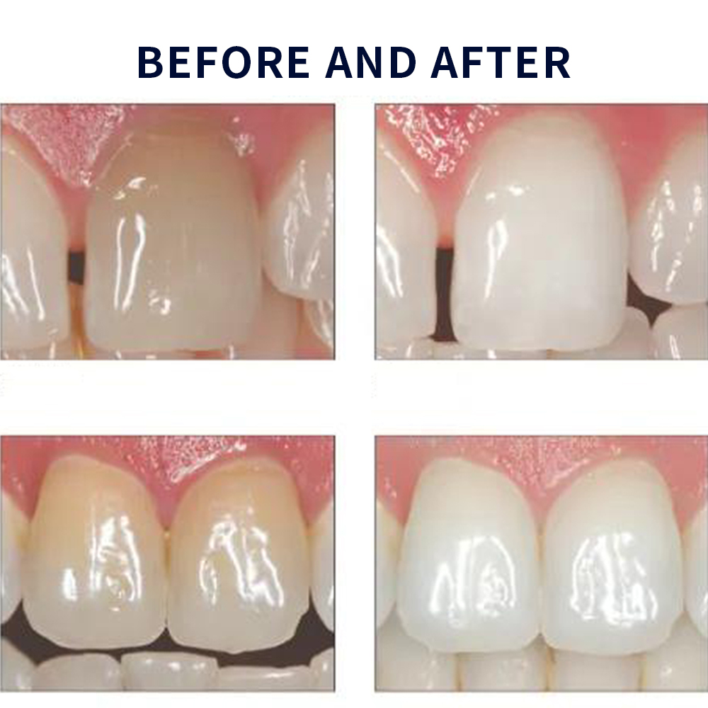 Opalescence Whitening 20% PF 2 - đánh giá và giá Teeth Whitening Before And After