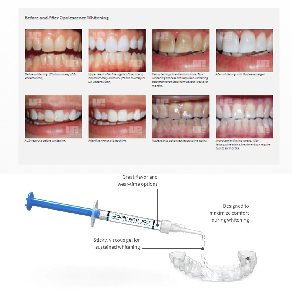 Opalescence Whitening 20% PF 2 - đánh giá và giá Teeth Whitening Before And After