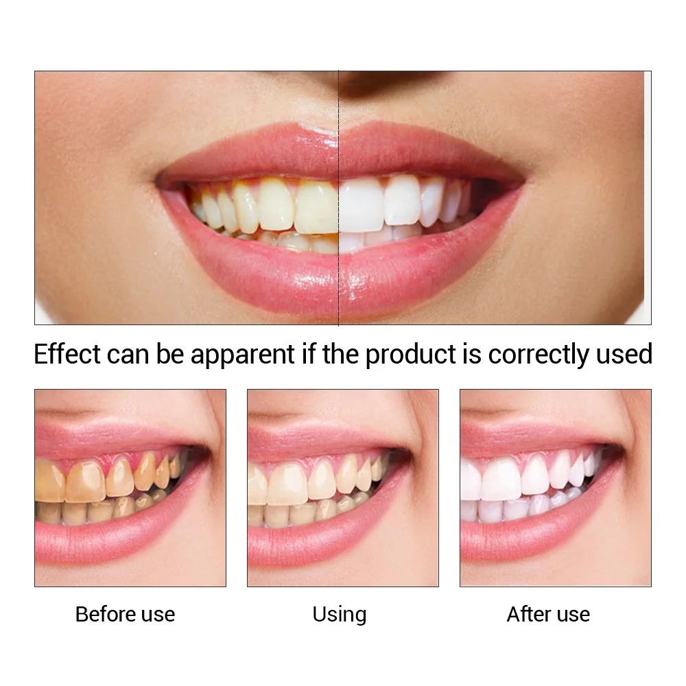 FTEENPLY Làm Trắng Răng Tinh C - đánh giá và giá Teeth Whitening Results