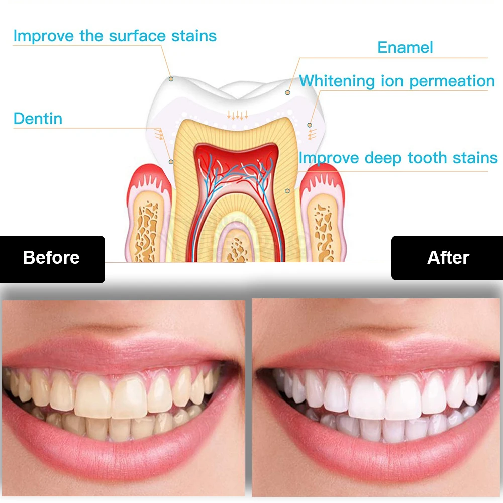 Dental Teeth Whitening Kit Min - đánh giá và giá Teeth Whitening Gel Pen